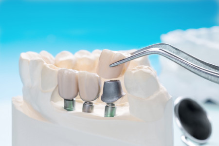 close-up-dental-implant