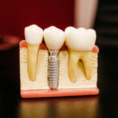 dental-implants