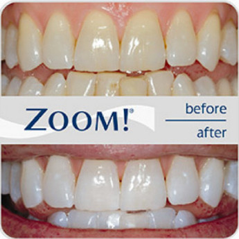 zoom-teeth-whitening