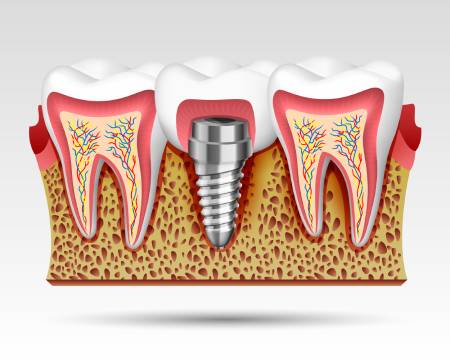 tooth-implant