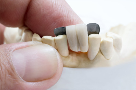 dental-bridge-restoration