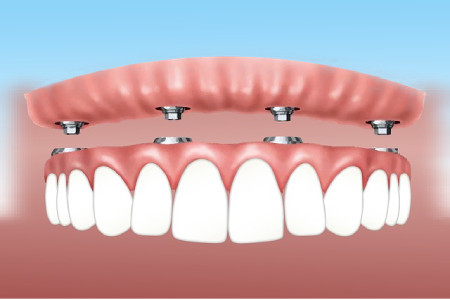 implant-dentures